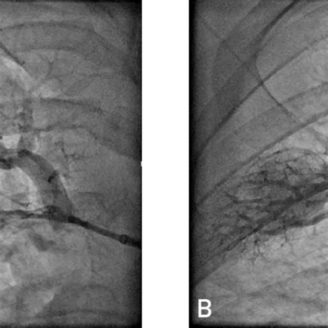 Figure Pulmonary Artery Angiography Before And After Balloon Pulmonary