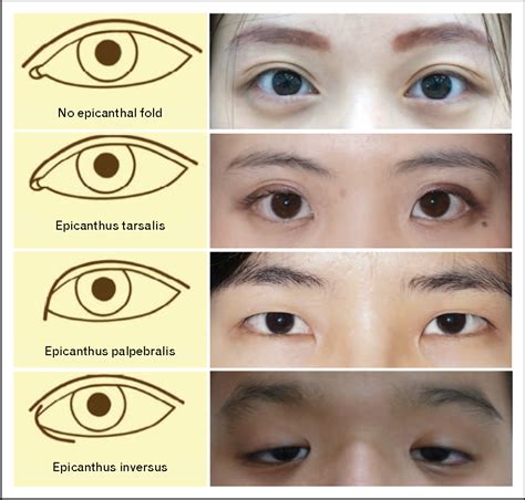 Figure 2 From The New Focus On Epicanthoplasty For Asian Eyelids