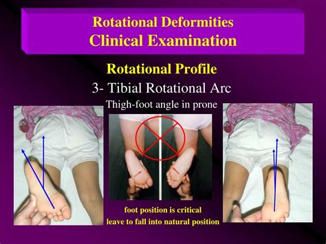 Ppt Angular Deformities Of Ll Bow Legs Knock Knees Rotational