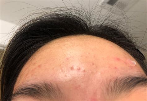 Acne Persistent Forehead Acne All Else Is Pretty Clear Help R