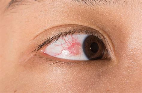 Episcleritis Causes And Treatment All About Vision