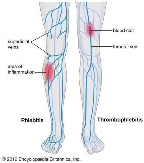 Phlebitis Vs Thrombophlebitis Venous And Other Health Pinterest