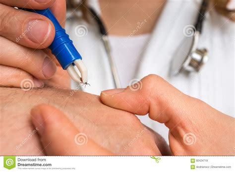 Doctor Removing A Tick With Tweezers From Hand Of Patient Stock Image