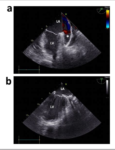 Figure 3 From Anterior Pathway For Epicardial Left Atrial Appendage