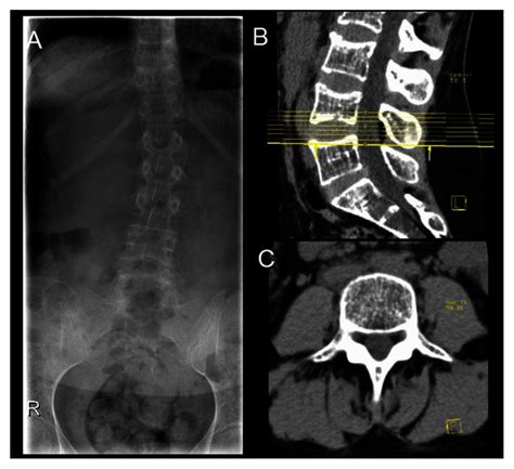 Lumbar Spine X Ray A And Computed Tomography Scan B Sagittal View