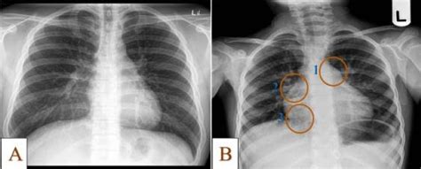 This image shows no abnormality at the left lung base. (A) portrays a normal X-ray of the chest with no notable ...