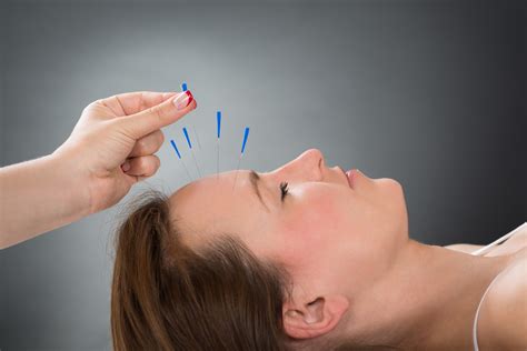 Acupuncture Helpful For Acute Preventive Treatment Of Migraine But