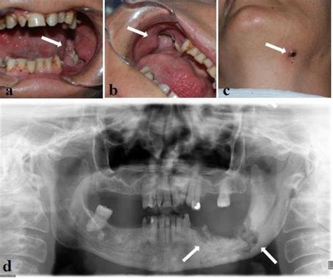Clinical Photographs And Radiographic Image From Case Report 2 Ab
