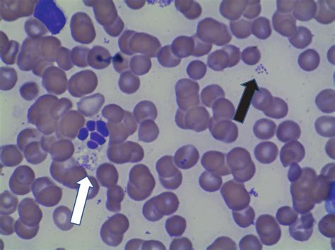 Blood Smear Degenerate Neutrophil With Intracellular Bacterial Rods
