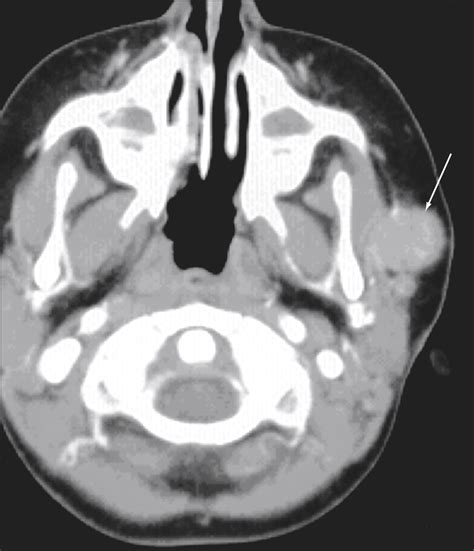 Mucoepidermoid Carcinoma Of The Parotid Gland In Children A 10 Year