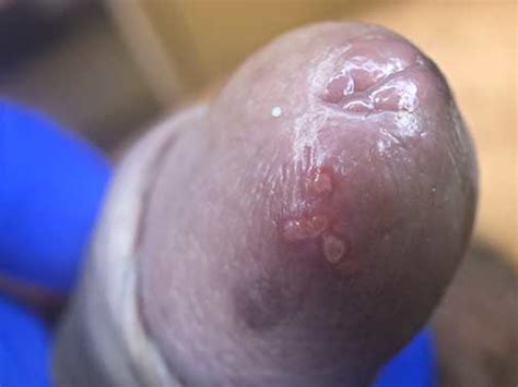 Herpes genital en hombres Síntomas tratamiento y cura