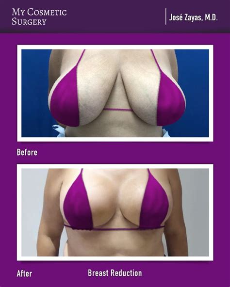 before and after a breast reduction done by jose zayas m d at my cosmetic surgery miami if