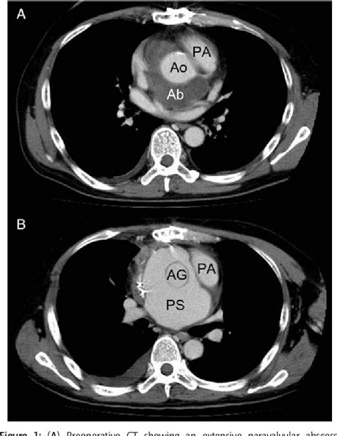 Figure 1 From Radical Surgical Repair With Stepwise Cabrol Shunt For