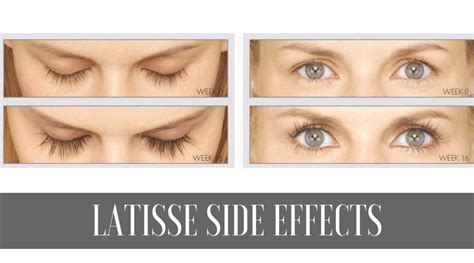 To use the latisse product, apply the solution as instructed once each day and you're ready to watch those. Side Effects of Latisse On Eyelashes. 5 Stories from Real ...