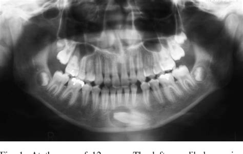 Figure From Transmigration Of Impacted Mandibular Canine To Opposite