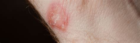 Fungal Infection Treatment By Dr Divya Sharma