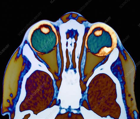 Eye Cancer Mri Scan Stock Image M1340480 Science Photo Library