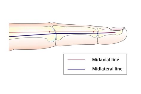 【free Illustrations】bruners Incision Midlateral Incision Midaxial