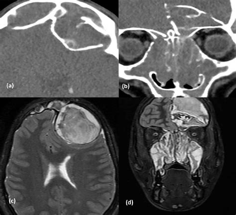 An Axial Ct A And A Coronal Ct B Of A Left Frontal Mucocele With