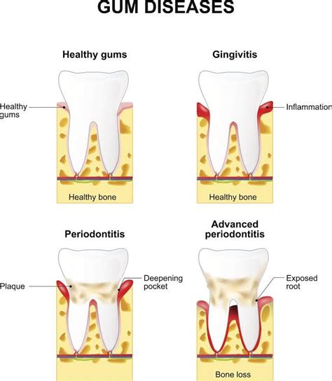 Gingivitis Vs Periodontitis Whats The Difference Ad Dentist