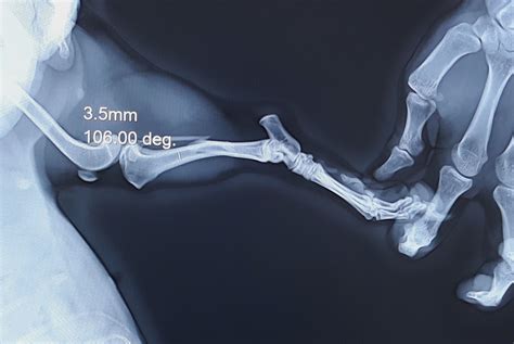 Tibial Long Oblique Diaphyseal Fracture Vetrainorg