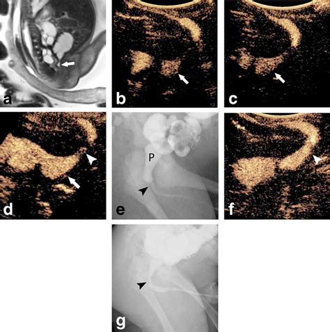 Infant With Posterior Urethral Valves Imaged Prior To A E And After Download Scientific