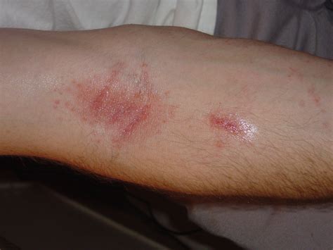 Flat Red Rash On Arms