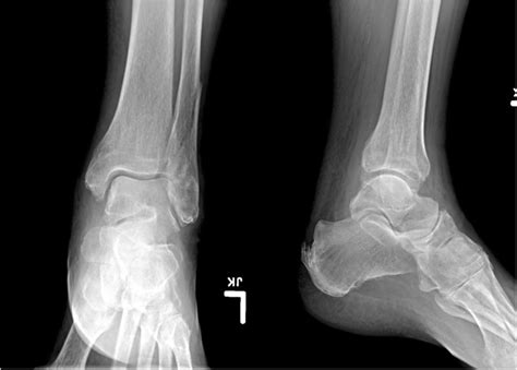 A Seemingly Innocuous Non Displaced Weber B Distal Fibula Fracture In A
