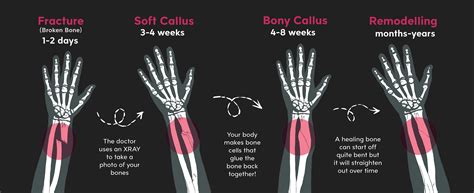 It is imperative that you see a medical professional who can ensure that the bone is correctly set before the healing starts. Emma Scheltema Illustration - Bone Healing for Starship ...