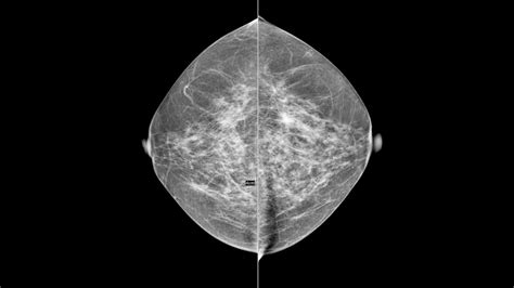 Understanding Your Mammogram Results