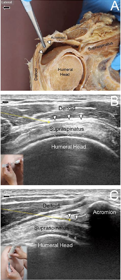 Diagram Of Shoulder Bursa Hip Bursitis Orthoinfo Aaos It Is A Thin