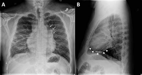 Chest X Ray Showing Enlarged Mediastinum At The Aortopulmonary Window