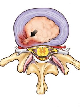 As we eluded to in the last section, learning nutritional basics and keeping an eye on your. Bulging Discs Healing - 3 Tips - How To Heal Disc NATURALLY