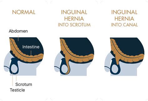 Types Of Hernia Diagram