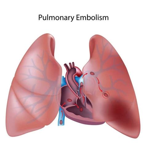 10 Signs Of Pulmonary Embolism Pulmonary Embolism Symptoms