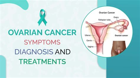 Ovarian Cancer Symptoms Diagnosis Treatment Body Revival