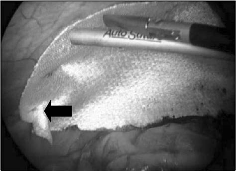 Figure 2 From Laparoscopic Inguinal Hernia Repair By Intraperitoneal
