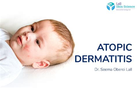 Dos And Donts To Follow For Atopic Dermatitis In Babies