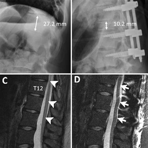 Preoperative A And Postoperative B Lateral Radiographs Obtained In