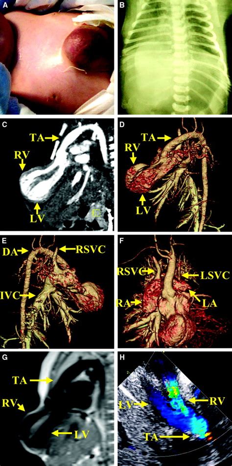 Pentalogy Of Cantrell Associated With Thoracoabdominal Ectopia Cordis