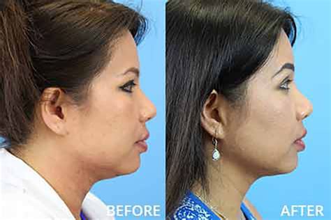 Kybella Injections Facial Plastic Surgery Center Washington