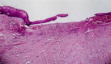 Cervical Ectropion Light Micrograph Stock Image Image Of Cervix