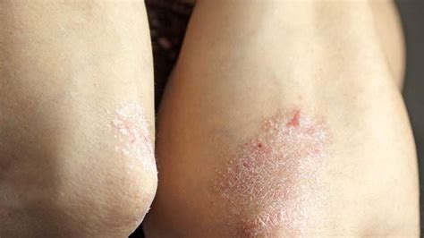 All About The Different Types Of Psoriasis Keep Asking