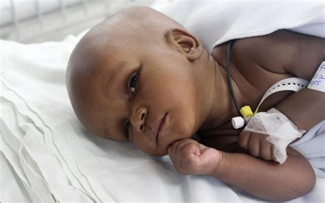 Surgery For Saving Babies From Water On The Brain Developed In Uganda