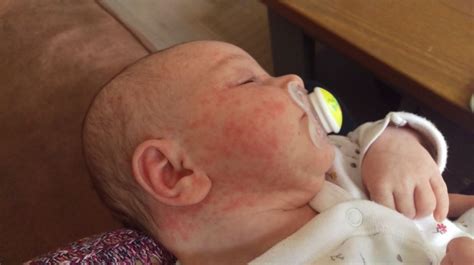 Newborn Rash Baby Acne Or Eczema Babycentre