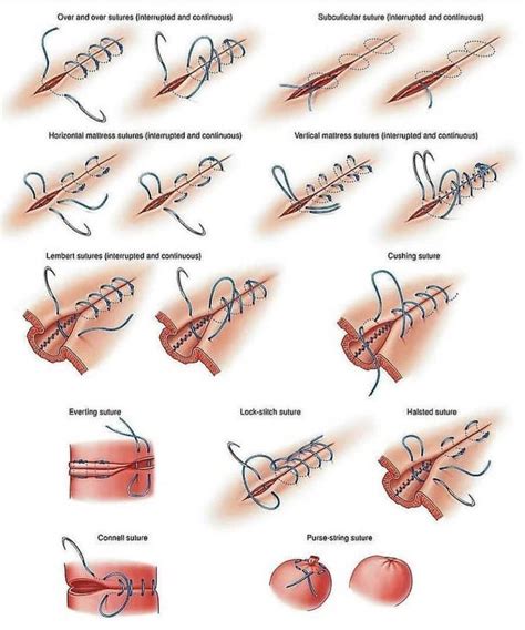 Medical Lifes Instagram Profile Post Different Types Of Suture