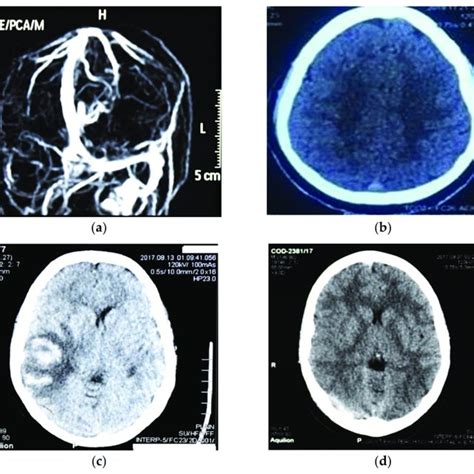 Imaging Details Of The Complications Presented In Cvst Patients A