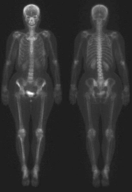 Illustrations Of A Nuclear Medicine Whole Body Bone Scan Images In A