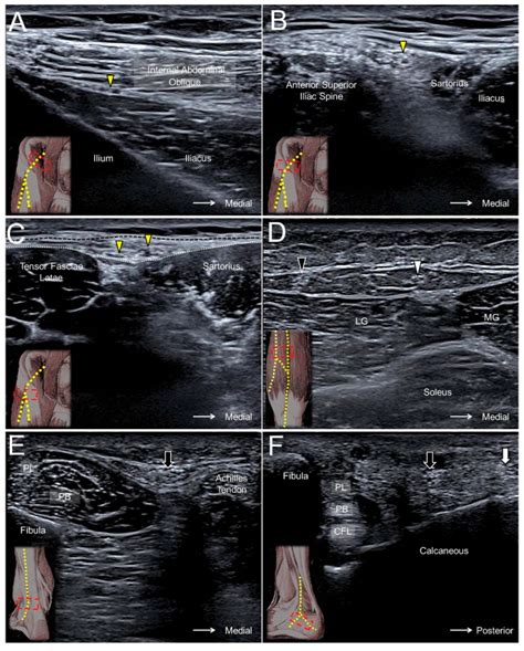 Lateral Femoral Cutaneous Nerve Mri