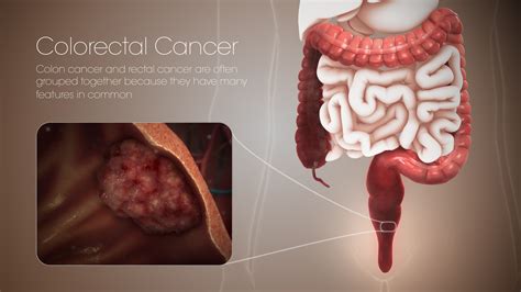 Colon Cancer Tumor